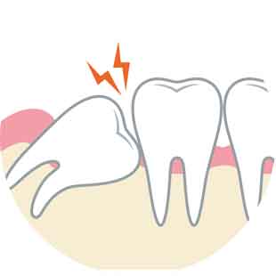 親知らず診断・抜歯
