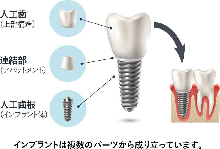 インプラントの構造