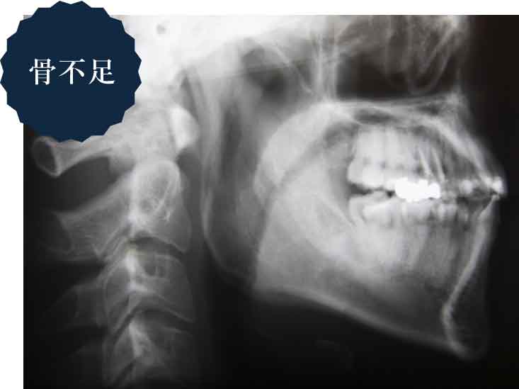 骨不足