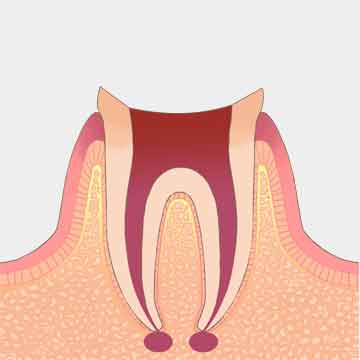 神経または詰め物の除去