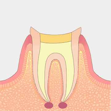 根管内部がきれいになるまで薬の交換