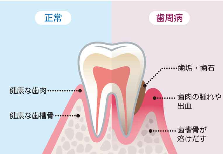 歯周病とは